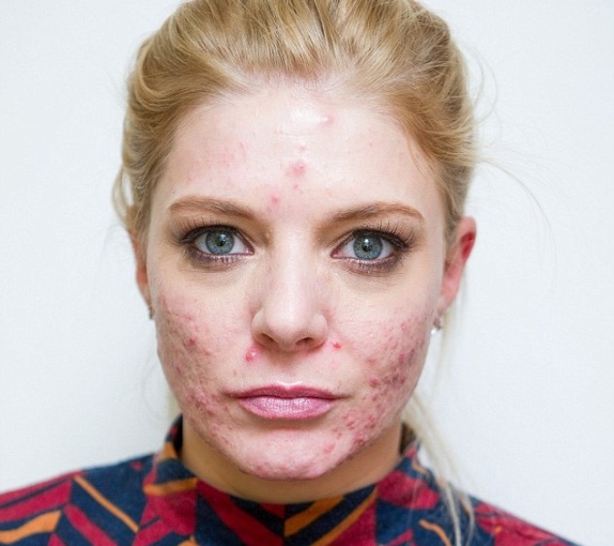 Έκανε θεραπεία με λέιζερ για να «φρεσκάρει» την επιδερμίδα της και έβγαλε… ακμή και φρικτά σημάδια! (Photos) - Media