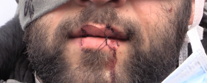 Καλαί: Πρόσφυγες έραψαν το στόμα τους διαμαρτυρόμενοι για το γκρέμισμα του καταυλισμού (Video) - Media