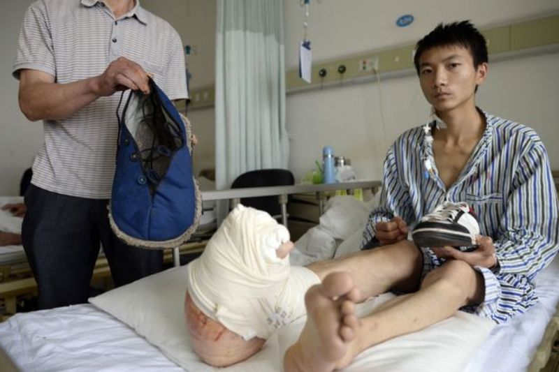 Κίνα: Άνδρας περπατά με το «πόδι του Φρανκενστάιν» - Media