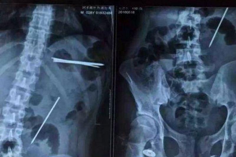 Κατάπιε… καρφιά για να εντυπωσιάσει τους φίλους του (Photo) - Media