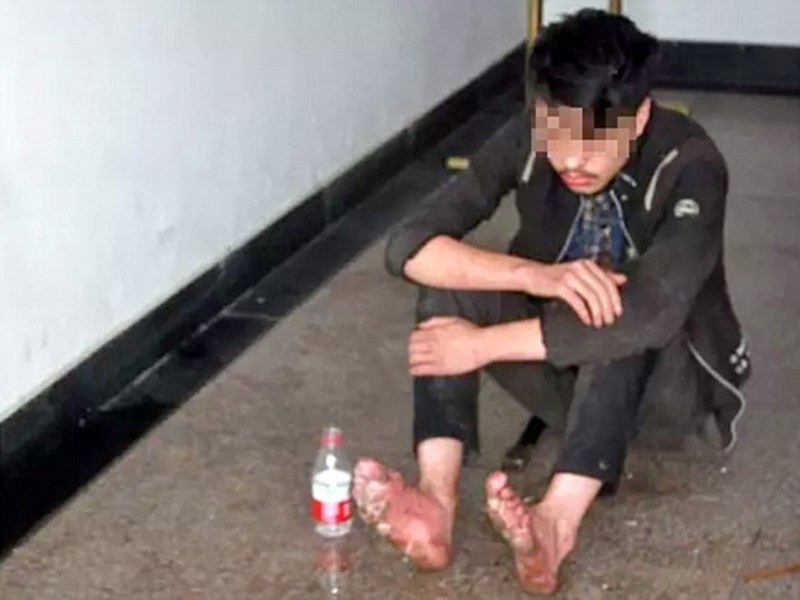 Κίνα: «Σάπισαν» τα πόδια του μετά από 6 ημέρες ηλεκτρονικών παιχνιδιών σερί (Photos) - Media