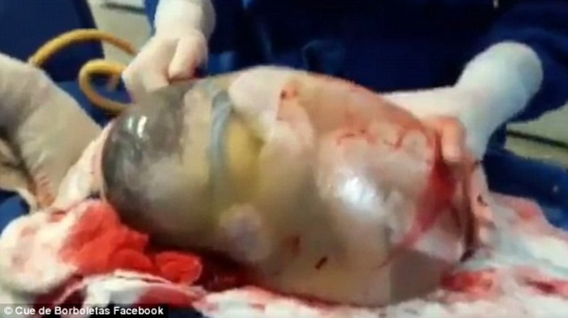 Εντυπωσιακό βίντεο από σπάνια γέννα: Μωρό γεννήθηκε μέσα στον αμνιακό σάκο - Media