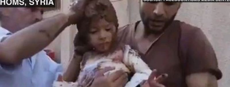 Νέο συγκλονιστικό βίντεο από Συρία: Γιατροί φροντίζουν τα εγκαύματα παιδιού με λάσπη - Media