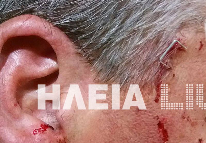 Ηλεία: Του κάρφωσε το συρραπτικό στον κρόταφο σε καβγά - Media