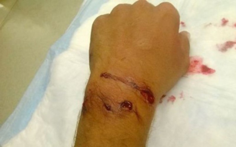 Ρόδος: Αθωώθηκε η 42χρονη που δάγκωσε 40χρονο για να μην τη συλλάβει  - Media