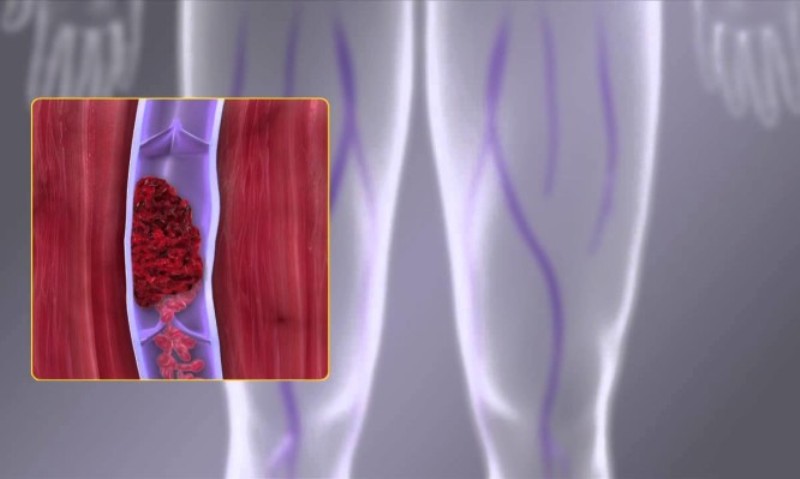 Φλεβική θρόμβωση: Ποιοι κινδυνεύουν από τον «σιωπηλό δολοφόνο» - Media