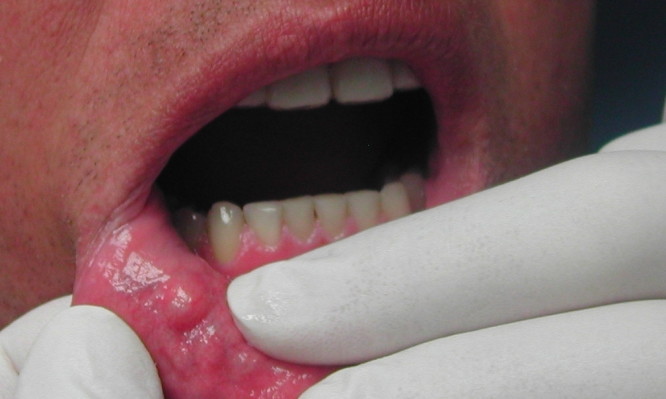 Προσοχή στα «αθώα» σημάδια για καρκίνο του στόματος  - Media
