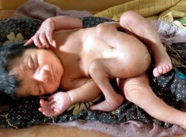 Το μωράκι τους γεννήθηκε με τέσσερα πόδια - Γιατί δεν ήθελαν να εγχειριστεί; (Video) - Media