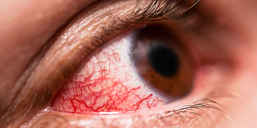 Μάτια που κοκκινίζουν: 10 πιθανές αιτίες & τι να κάνετε - Media