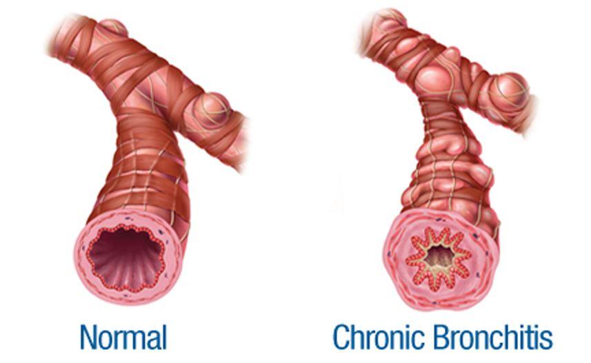 Βρογχίτιδα: Αίτια, συμπτώματα, επιπλοκές και μέθοδοι αντιμετώπισης  - Media