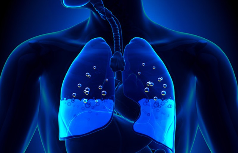 Τα «μικρά» συμπτώματα που δείχνουν συσσώρευση υγρού στον πνεύμονα - Media