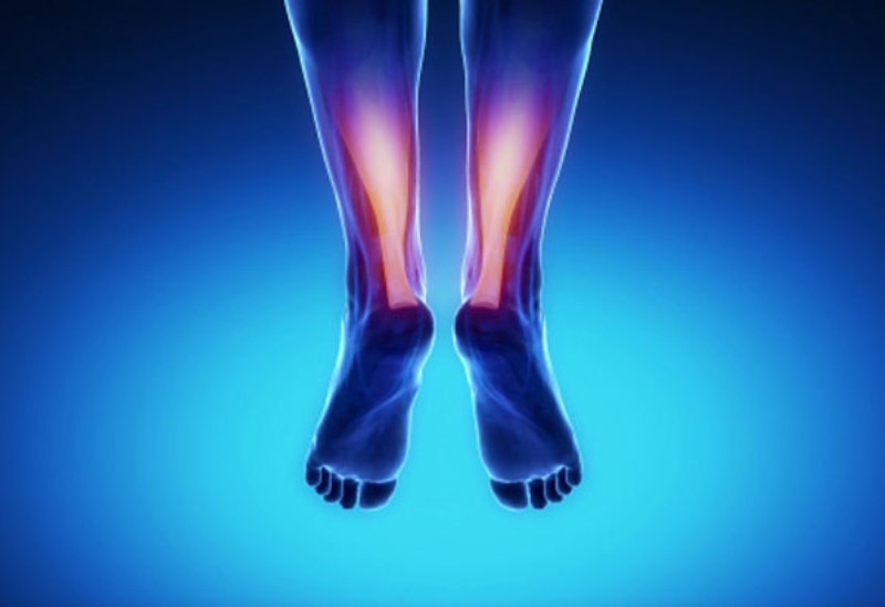 Τενοντίτιδα αχιλλείου: Τι είναι και ποιοι κινδυνεύουν - Media
