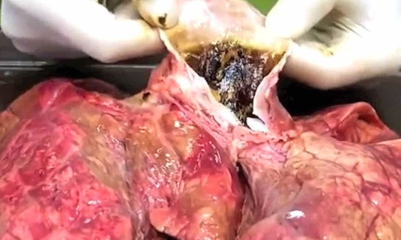 Τι κάνει το τσιγάρο στους πνεύμονες: Το βίντεο που σόκαρε τους καπνιστές παγκοσμίως - Media