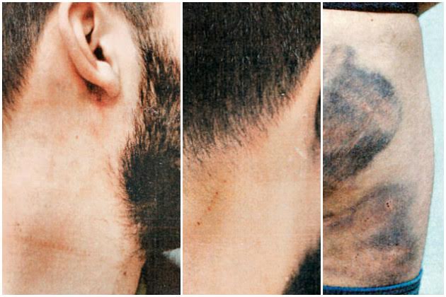 Πάτρα: Καταγγέλλει αστυνομικούς για άγρια βασανιστήρια (Photos) - Media