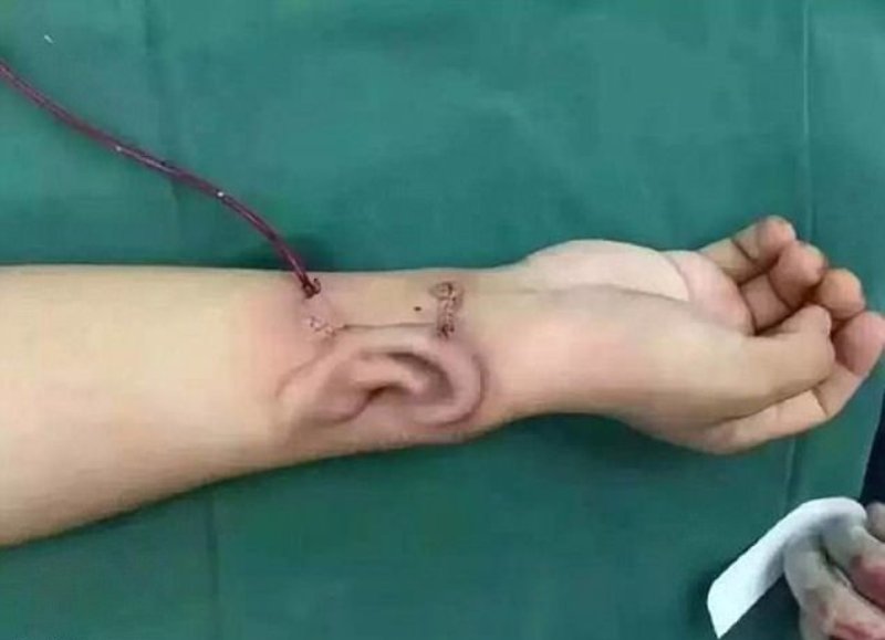 Απίστευτο: Του «φύτρωσαν» αυτί στο μπράτσο και του το μεταμόσχευσαν (Photos) - Media