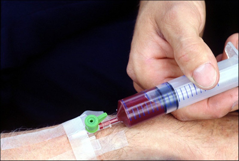 Νέο πειραματικό τεστ ανιχνεύει εγκαίρως τον καρκίνο στο πάγκρεας - Media