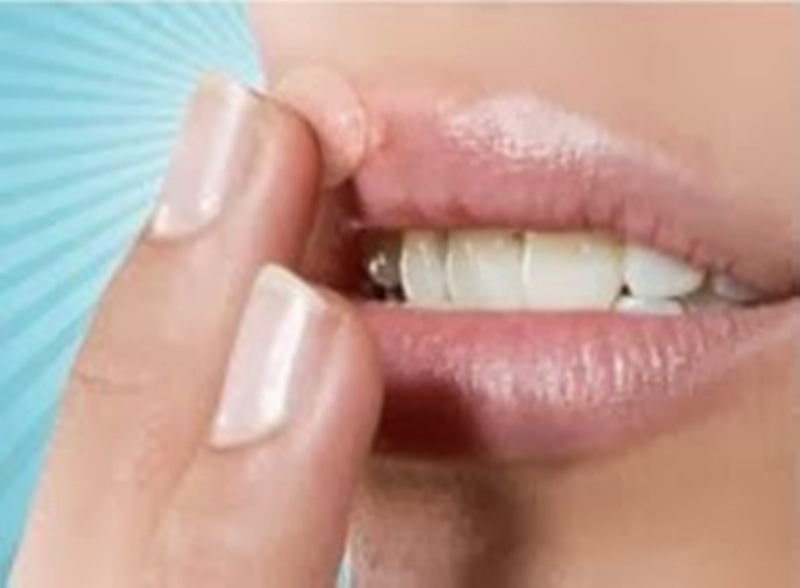 Επιχείλιος έρπης: Εξαφανίστε τον άμεσα, χωρίς φάρμακα… - Media