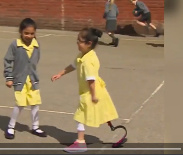 7χρονη δείχνει στους φίλους της το τεχνητό της πόδι: Η αντίδρασή τους θα σας καταπλήξει! (Video) - Media