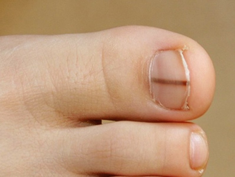 Προσοχή: Τι σημαίνει αν δείτε αυτό το σημάδι στο νύχι σας (Photo-Video) - Media