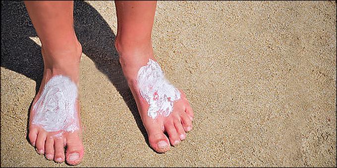 Ηλιοθεραπεία: Τι να κάνετε εάν καείτε από τον ήλιο  - Media