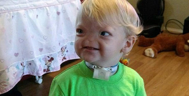 «Έφυγε» στα δυο του χρόνια το αγοράκι που γεννήθηκε χωρίς μύτη - Media