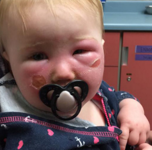 Μωρό εισήχθη στην εντατική με εγκαύματα εξαιτίας του αντηλιακού  (Video + Photos) - Media