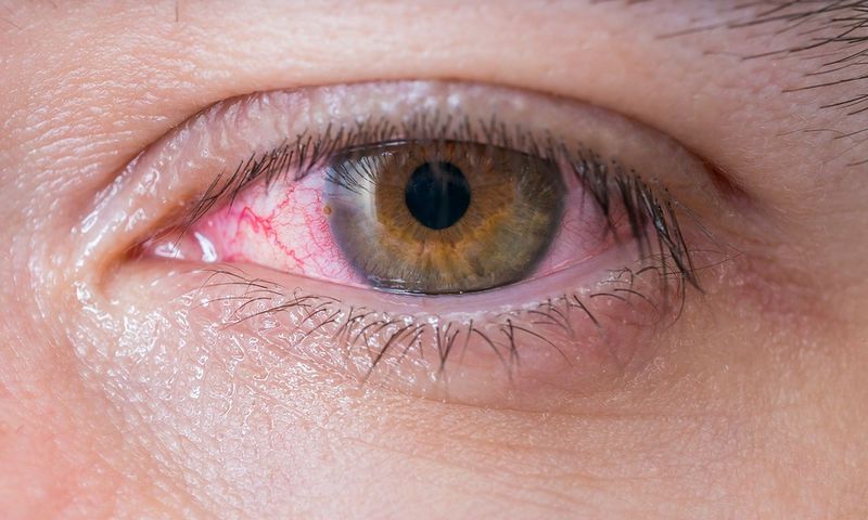 Επιπεφυκίτιδα: Το συχνό λάθος που παρατείνει τα συμπτώματα και τη δυσφορία - Media