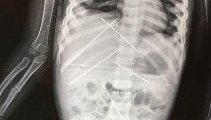 Φρίκη! Γεμάτο βελόνες το σώμα μωρού από τελετές μαύρης μαγείας (Photos) - Media