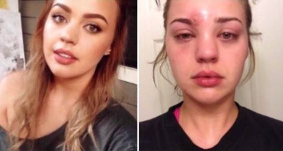 Δεν ήταν σπυράκι, αλλά ύπουλος σταφυλόκοκκος και παραλίγο να τυφλωθεί! - Τι ΔΕΝ έπρεπε να κάνει - Media