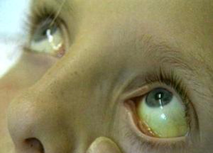 Βλάβη στο συκώτι: Τα 6 πρώιμα σημάδια που πρέπει να γνωρίζετε - Media