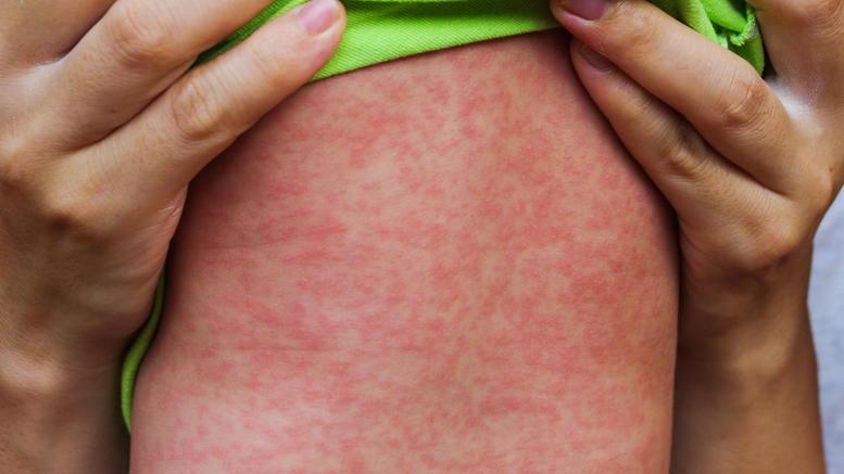 Αυτά είναι τα συμπτώματα της ιλαράς – Πώς να προφυλαχθείς - Media