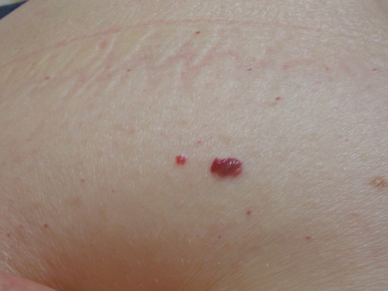 Κόκκινες ελιές στο δέρμα: Πότε να επισκεφθείτε τον γιατρό!  - Media