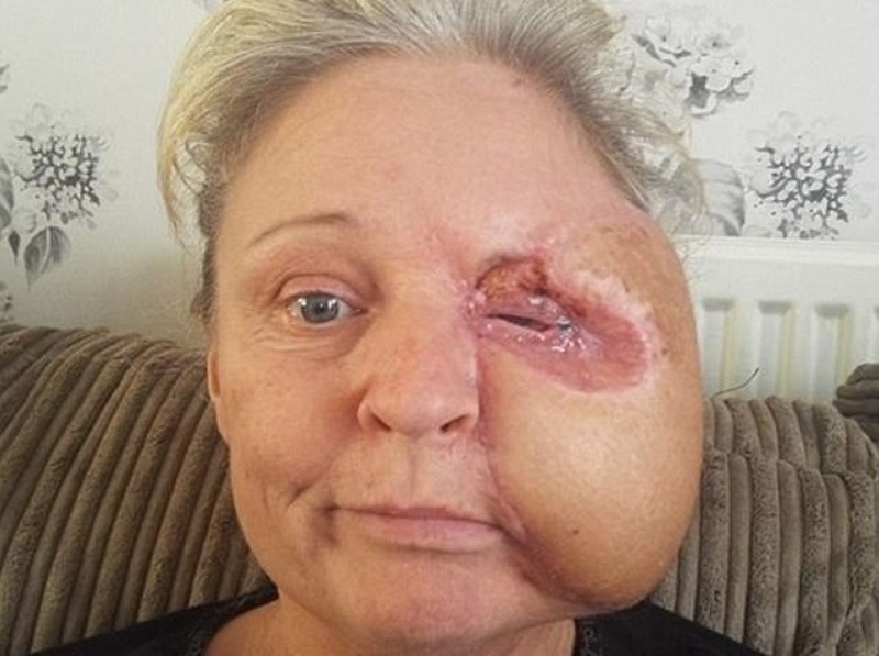 Σαρκοφάγος μικροοργανισμός κατέστρεψε το μισό πρόσωπο μητέρας – Χτύπησε το κεφάλι της στον φούρνο (Σκληρές Photos) - Media