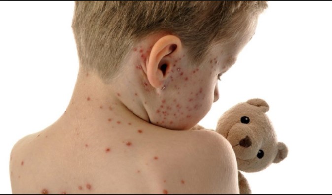 «Θερίζει» η ιλαρά! 50 περιστατικά μέσα σε 15 μέρες – Τι πρέπει να κάνουν οι γονείς - Media