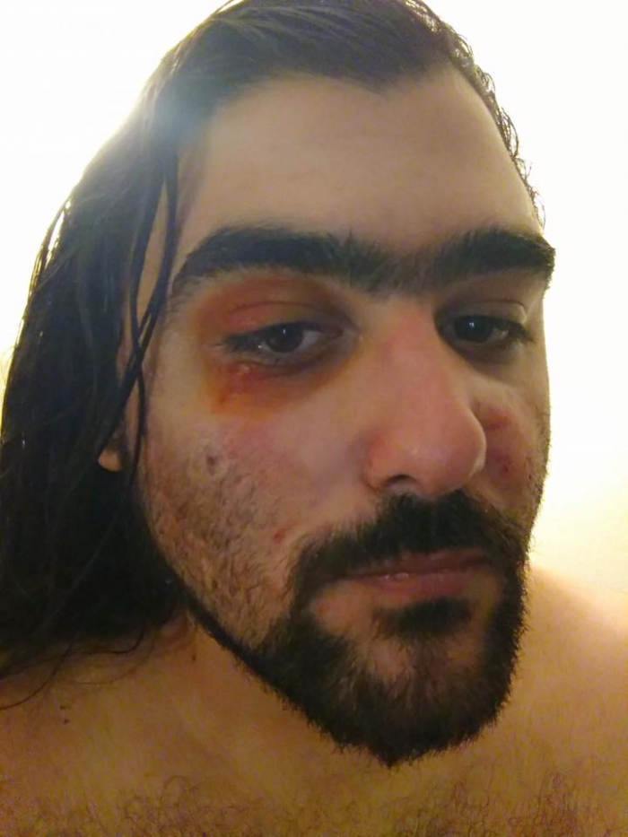 Ξυλοφόρτωσαν νεαρό που φορούσε μπλούζα «Μολών Λαβέ» στη Θεσσαλονίκη – Τι αναφέρει ο ίδιος - Media