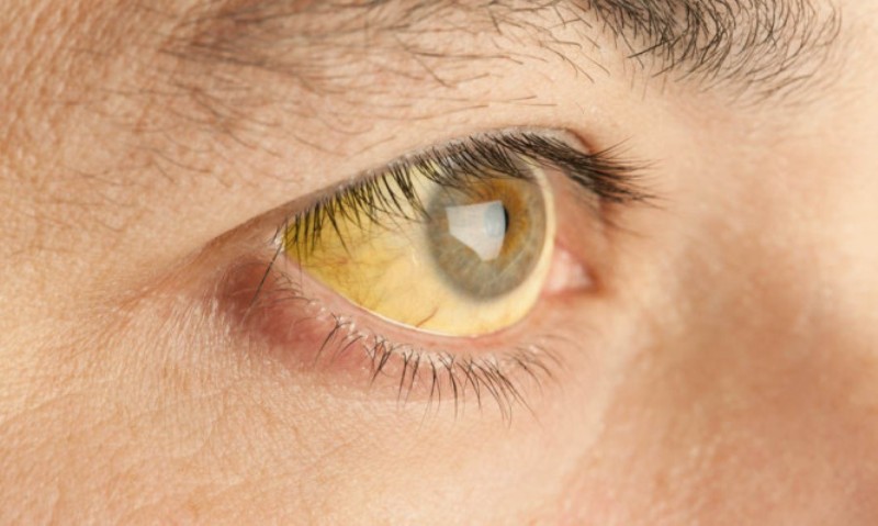Κίτρινα μάτια: Τι μαρτυρούν για την υγεία σας - Media