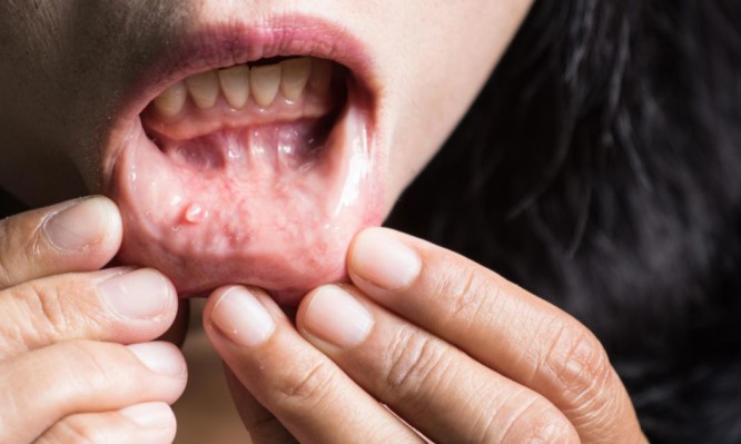 Τα 10 «αθώα» συμπτώματα για καρκίνο του στόματος - Media