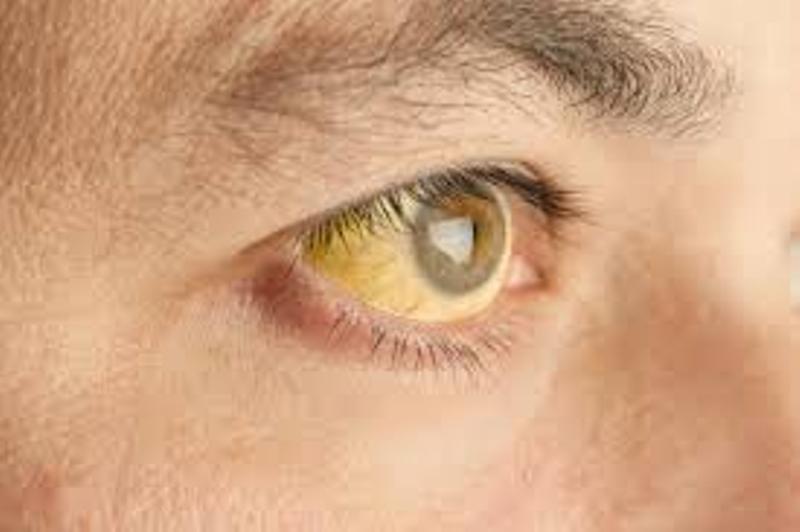 Κίτρινα μάτια: Με ποιες παθήσεις συνδέονται  - Media
