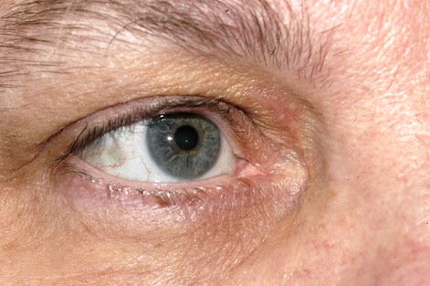 Έχετε αυτά τα σημάδια στα μάτια; - Τι προβλήματα αποκαλύπτουν για την υγεία σας (Photo) - Media