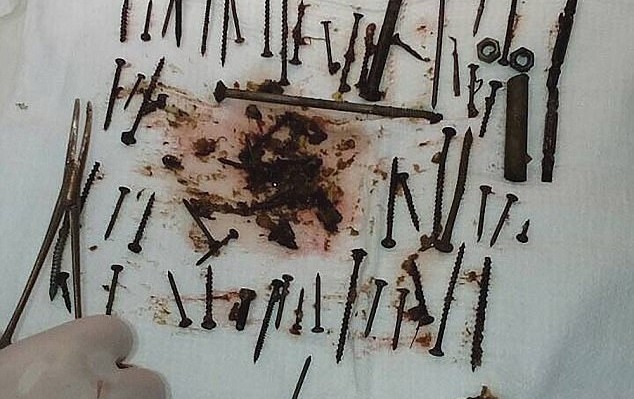 Είχε αναιμία: Κατάπιε 152 καρφιά και μπουλόνια για να αυξήσει τον «σίδηρο» στο αίμα της - Media