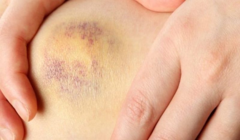 Ανεξήγητες μελανιές: Ποιες οι πιθανές αιτίες - Πότε να επισκεφτείτε γιατρό - Media