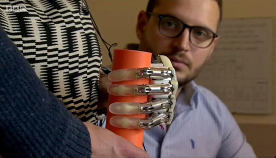 Δημιουργήθηκε το πρώτο βιονικό χέρι με αίσθηση αφής - Media