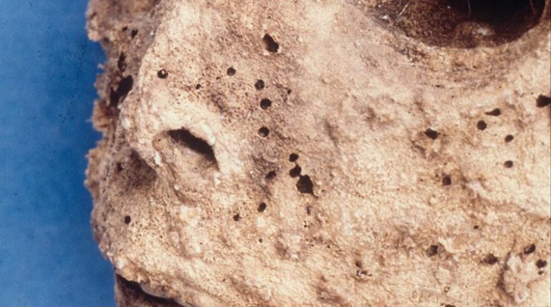 Το DNA της μεσαιωνικής μούμιας παιδιού έδειξε ότι είχε ηπατίτιδα Β - Media