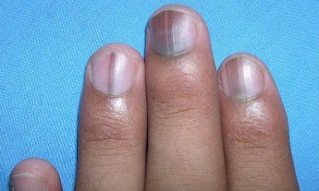 Αν δείτε αυτή τη μαύρη γραμμή στο νύχι σας, επισκεφθείτε άμεσα γιατρό!  - Media