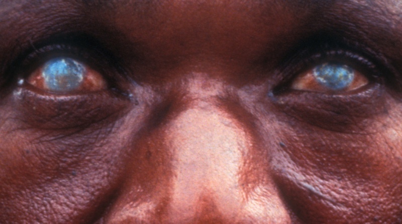 Η άγνωστη ασθένεια που προκαλεί τύφλωση (Photos, σκληρές εικόνες) - Media