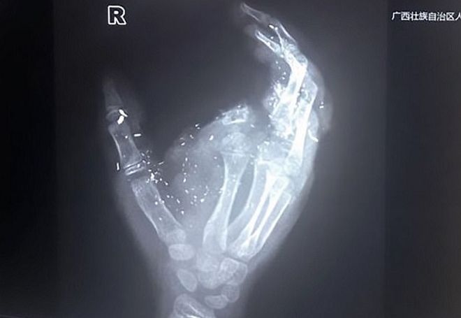 Δωδεκάχρονος έχασε ένα δάχτυλο και την όρασή του από έκρηξη κινητού (Video)  - Media