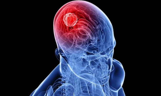 Όγκος στον εγκέφαλο: Ποιοι κινδυνεύουν περισσότερο - Τα πρώιμα συμπτώματα - Media