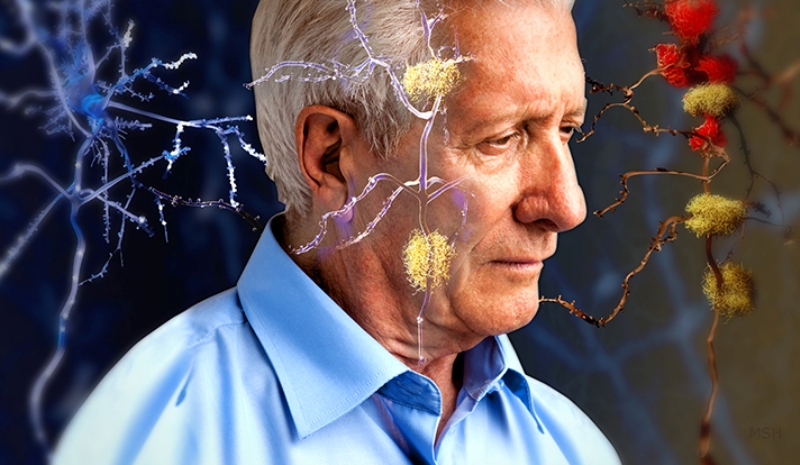 Το φάρμακο του Αλτσχάιμερ έρχεται σε 3-4 χρόνια - Media