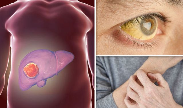 Μεταστατικός καρκίνος του παχέος εντέρου: Το ρόφημα που «καθυστερεί» τη νόσο - Media