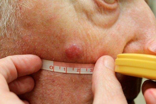 Καρκίνος δέρματος: Το πρώτο σημάδι που προειδοποιεί! (Video | Photo) - Media
